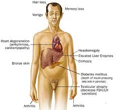 Image result for cirrhosis of liver symptoms