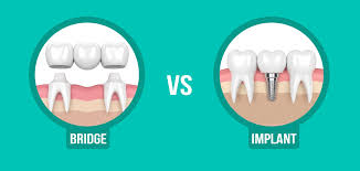 what is better tooth implant or bridge