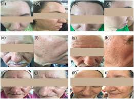 sebaceous hyperplasia of the face