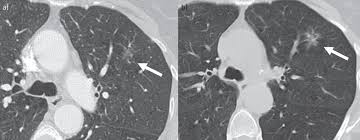 Slow Growing Lung Cancer As An Emerging