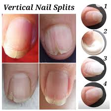 nail repair system for split nails
