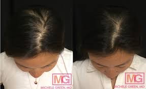postpartum hair loss pregnancy hair