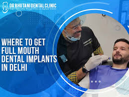full mouth dental implants in delhi
