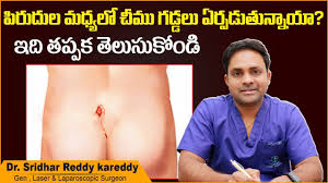 pilonidal sinus treatment in telugu