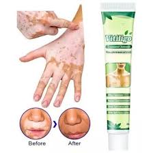Pomada Tratamento Vitiligo Sumifun - YA Skin Care - Pomada para Cabelo - Magazine Luiza