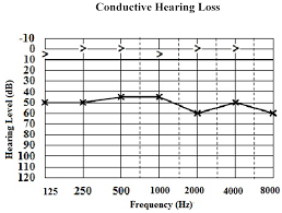 Classification Of Hearing Loss Intechopen