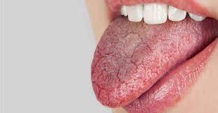 dry mouth or xerostomia causes