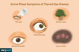 prognosis in thyroid eye disease