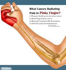 Symptoms of pain in pinky finger for people suffering from rheumatoid arthritis, the symptoms include stiffness, swelling and severe pain in the joints of the finger. What Causes Radiating Pain To Pinky Finger How Is It Treated