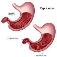 peptic ulcer disease jackson