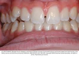 People are most susceptible to dental fluorosis between birth and severe cases of dental fluorosis will affect the entire tooth with brown discoloration and countless waves or streaks of an off white tone. Dental Fluorosis American Dental Association