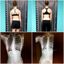 before after curvy spine