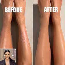 kim kardashian covers up her psoriasis