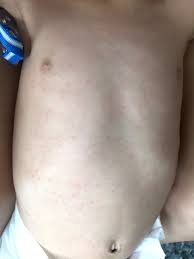 Juan luis camara singson, explain the symptoms and treatments to this mild illness. The Devil Is Roseola And How I Survived It Jo Lauren