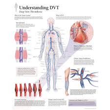 Understanding Dvt Deep Vein Thrombosis Chart