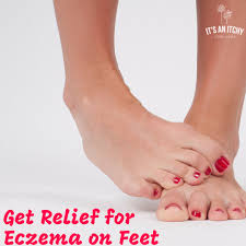 get relief for eczema on feet it s an