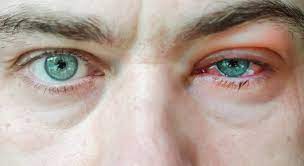 dry eyes blepharitis could be to blame