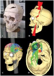 Case study about phineas gage   Top Essay Writing               Psychology s    Greatest Case Studies     Digested