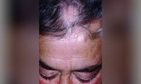 Hair loss may also be caused by several drugs and medications. There S No Cure For Alopecia Areata But Options Exist