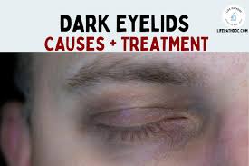 dark eyelids causes treatments and