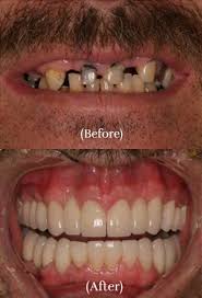 full mouth dental implants santa rosa