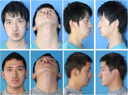 bilateral cleft lip and nasal deformity