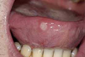 mouth ulcers hse ie