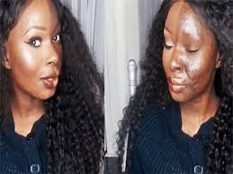 this burns victim uses power of makeup