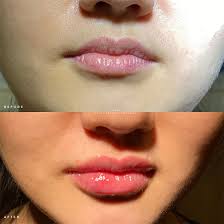 lip augmentation nyc lip augmentation