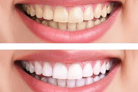 bleaching teeth whitening rh dental