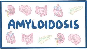 amyloidosis ask hematologist