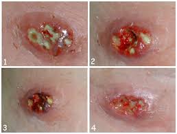Image result for septicemia