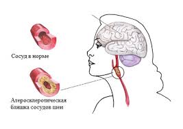 Энцефалопатией называется группа дизонтогенетических заболеваний головного мозга невоспалительного характера. Discirkulyatornaya Encefalopatiya Simptomy Diagnostika Golovokruzhenie
