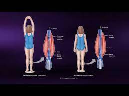 causes of muscle soreness coursera