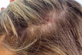 recurring scab on scalp in the same