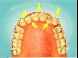 Metal Braces Dental Treatment Guide