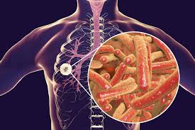 Resultado de imagen de tuberculosis