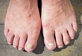 fungus toenails foot and ankle
