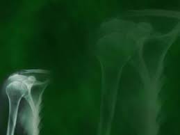 Collar Bone X Ray 01 Medicine Powerpoint Templates
