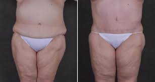 liposuction omaha ne lipo surgery