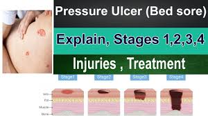 bed sores pressure ulcer ses