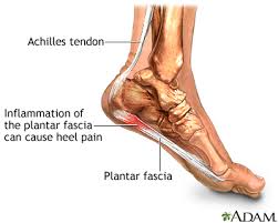 Foot problems can cause pain, inflammation, or injury. Plantar Fasciitis Medlineplus Medical Encyclopedia