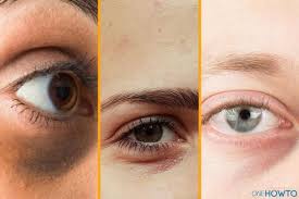 6 types of dark circles under the eyes