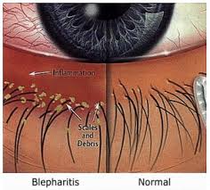 blepharitis oasis eye care
