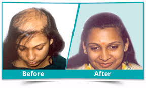 Learn from hairsite's top ranked faculty surgeons. Hair Transplant In India Compare Cost Treatments Enhance Clinics