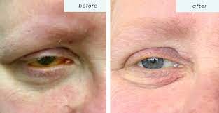 ipl treatments for dry eye skin