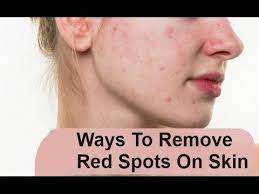 home tips to remove red marks from face