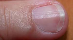 ridges in fingernails symptoms causes