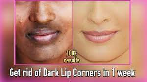 dark lip corners