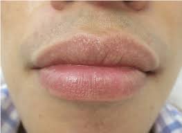 fordyce spots on the upper lip